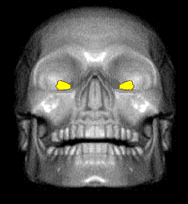 tetemort 80
